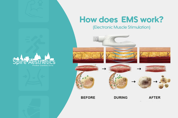 EMS treatment for post pregnancy weight loss treatment Croydon
