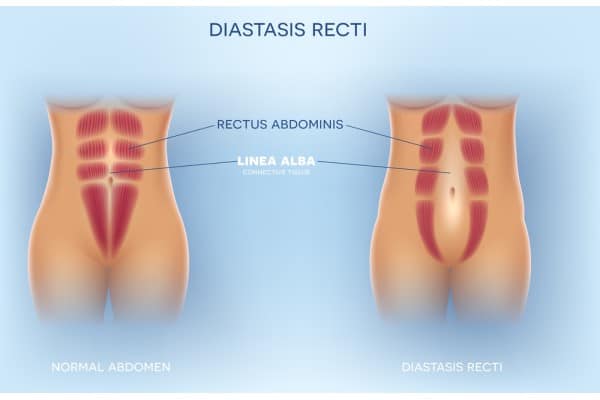 What Non-Surgical Options Are Available for Diastasis Recti Croydon?