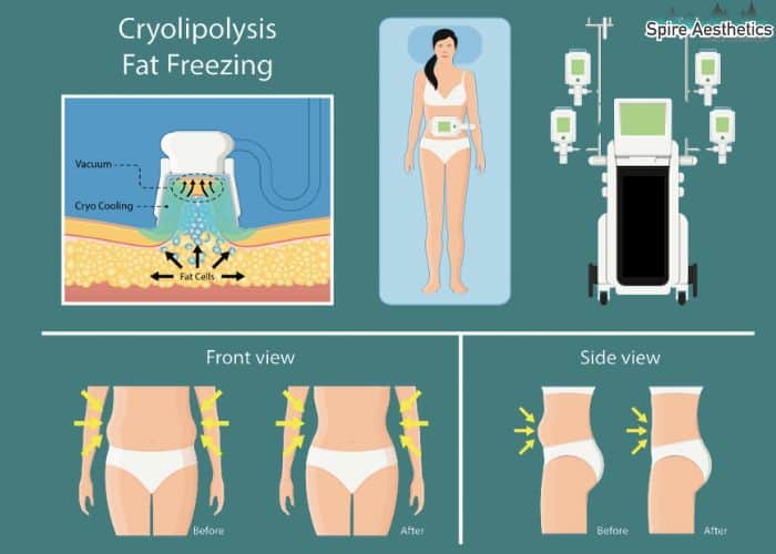 Image of diet and fat freezing combined for best results for Spire Aesthetics Croydon