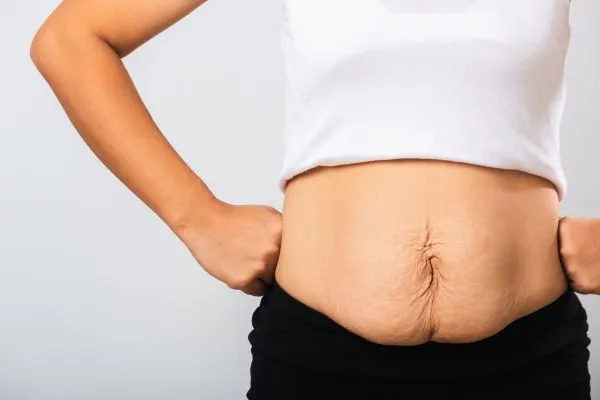 Image of a woman's stomach after weight loss with sagging skin following a gastric band Croydon