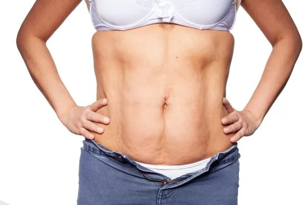 sagging skin on woman's stomach after weight loss injections Croydon