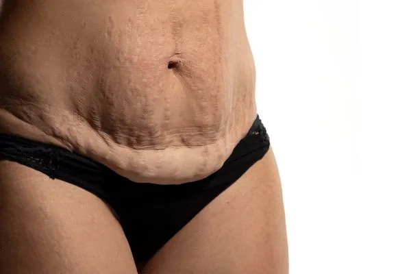 Image of womans stomach after weight loss injections Croydon showing saggy skin