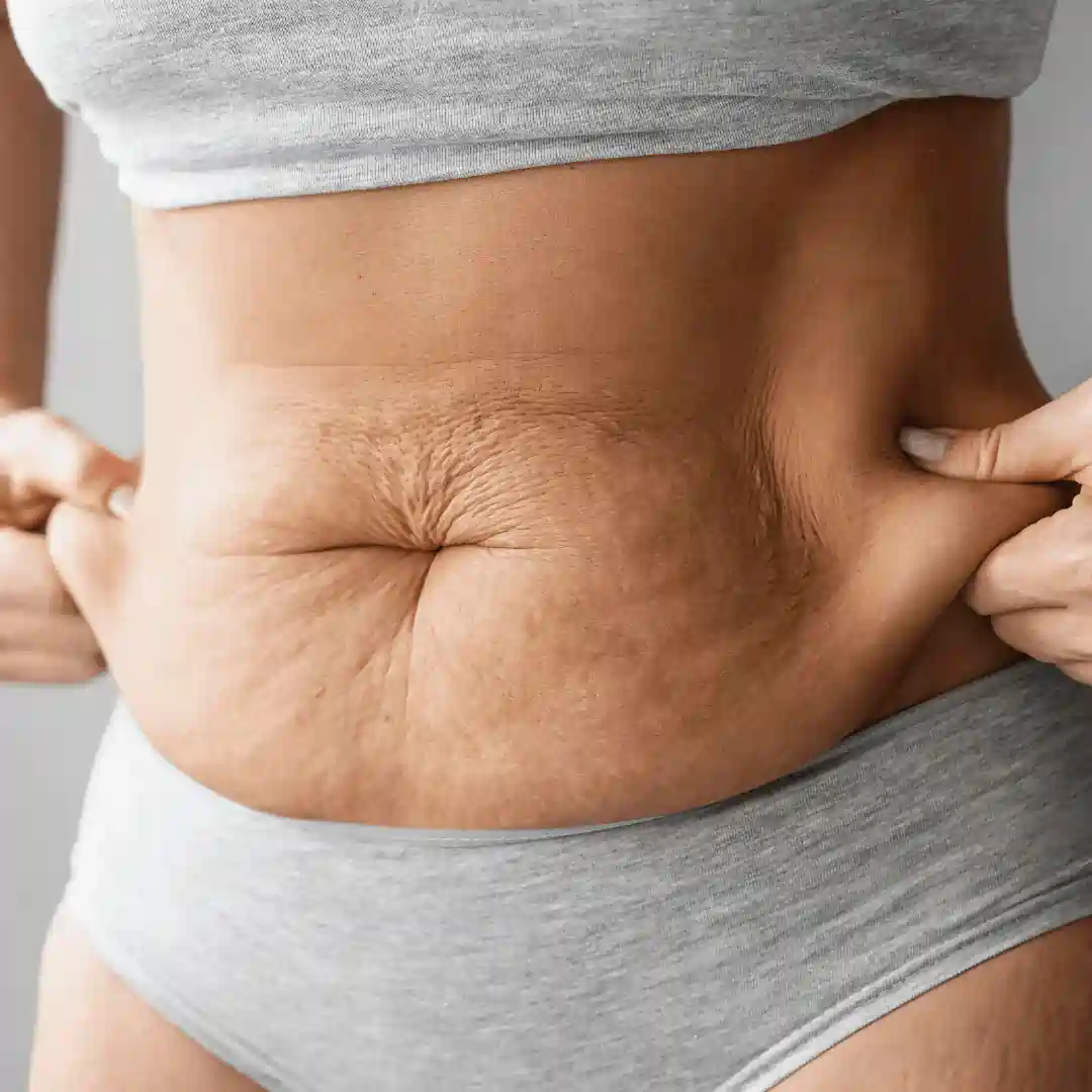 Is It Normal to Have Loose Skin After Pregnancy Croydon?