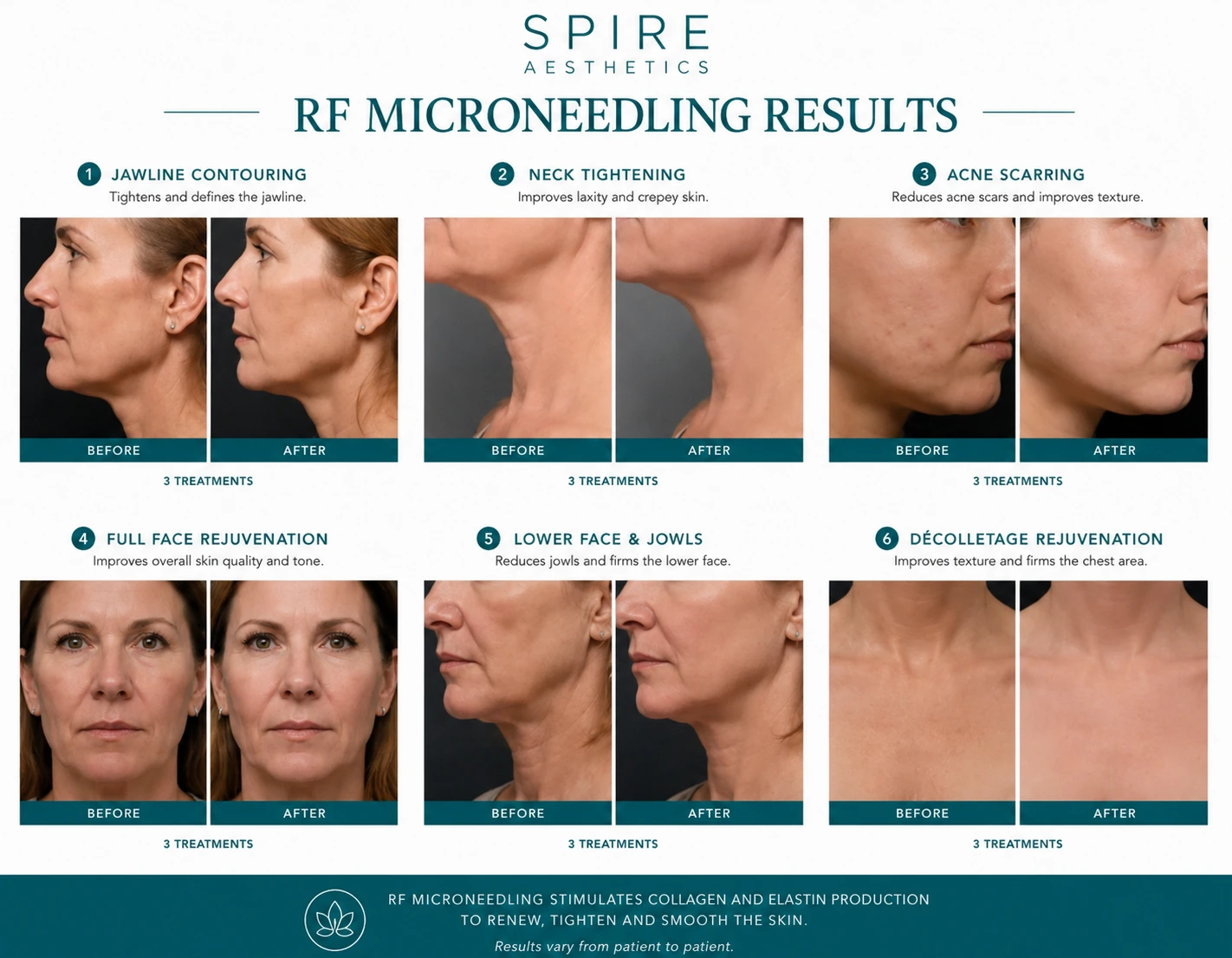 RF Microneedling Skin tightening Croydon results