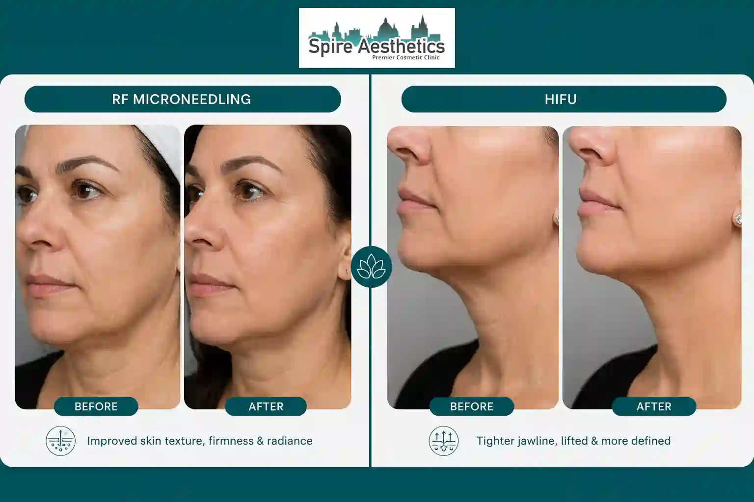 Can RF Microneedling and HIFU Be Combined Croydon?