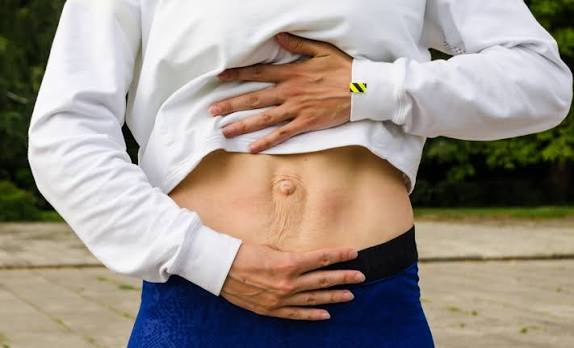 When Could Diastasis Recti Be the Missing Piece of the Puzzle Croydon?