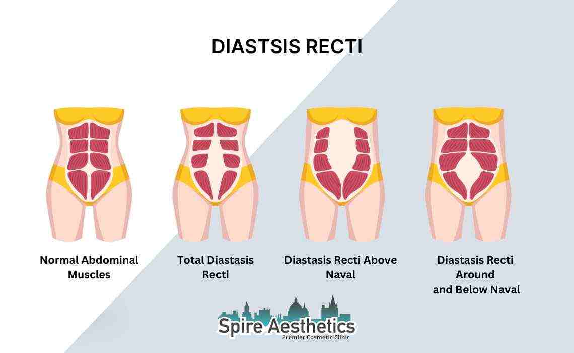 Is Non-Surgical Diastasis Recti Treatment Right for You? Common Concerns Answered Croydon